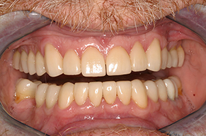 Full Mouth Reconstruction After Photo